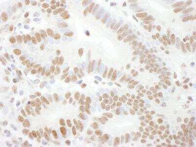 Immunohistochemistry: Rad17 [p Ser645] Antibody [NB100-273] - Sample: FFPE section of human colon carcinoma. Antibody: Affinity purified rabbit anti-Phospho Rad17 (S645) used at a dilution of 1:1,000 (1ug/ml). Detection: DAB